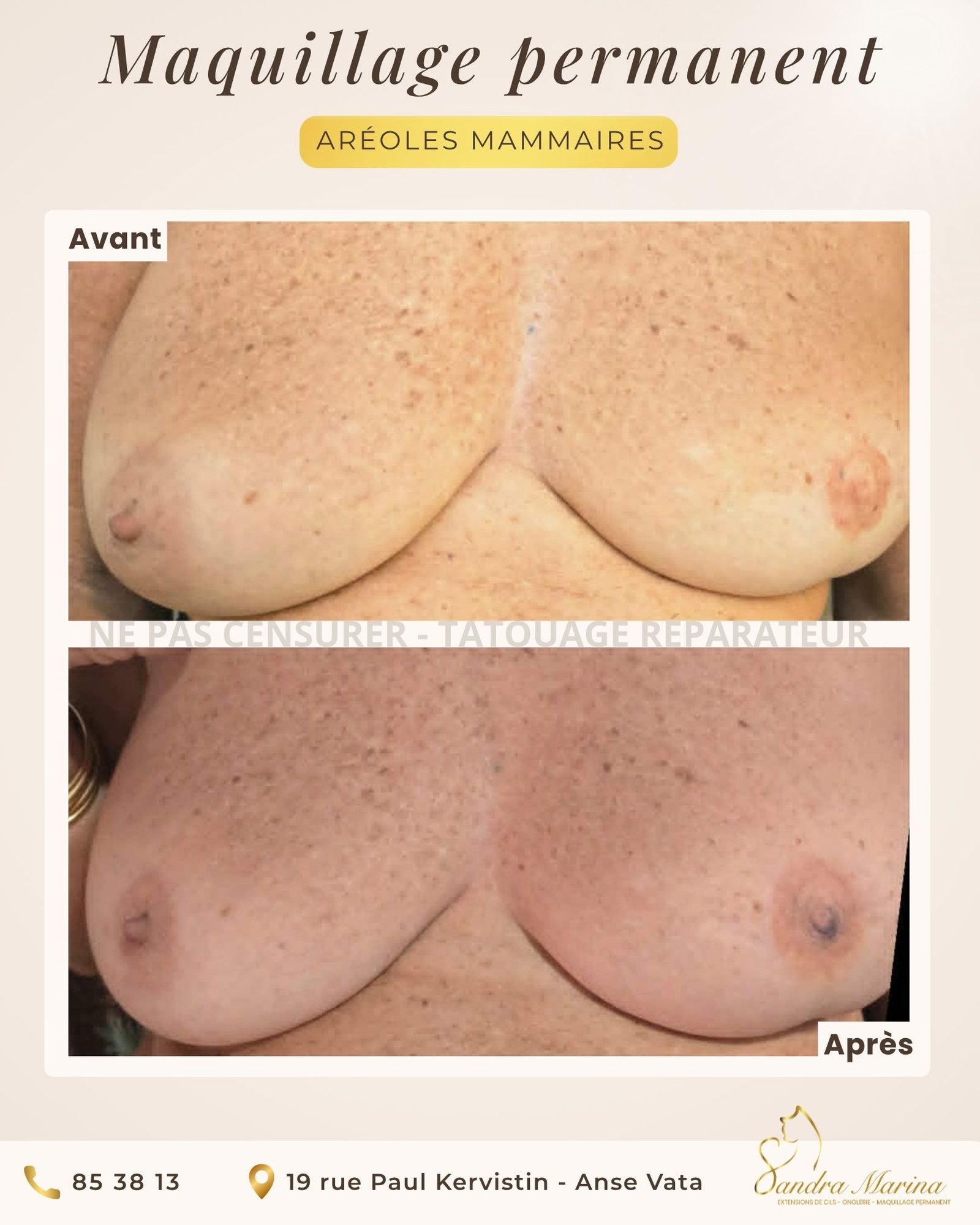 Dermopigmentation d’aréole mammaire avant après