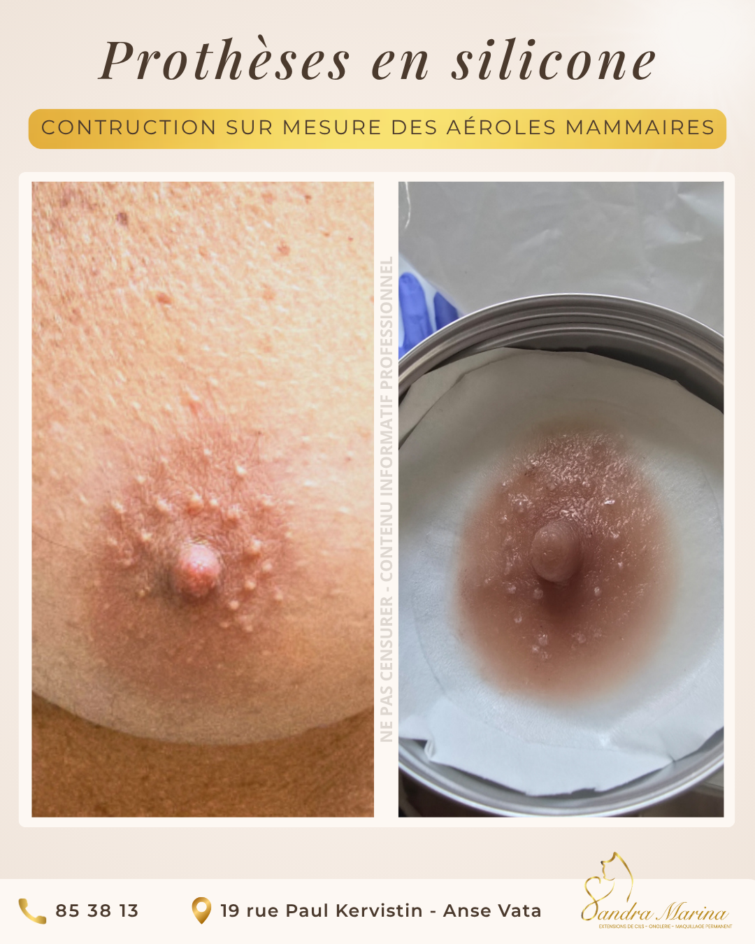 Reconstruction esthétique de l’aréole